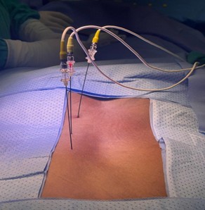 Procedimientos ortho spine center procedimientos rizolisis