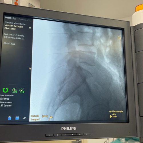 Radiofrecuencia lumbar b