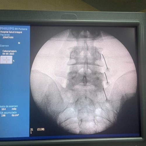 infiltracion lumbosacra