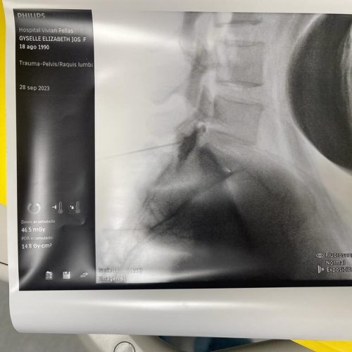 infiltracion sacra 1.1