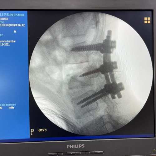 instrumentacion lumbar
