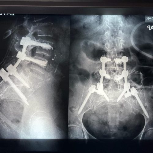 instrumentacion lumbosacra