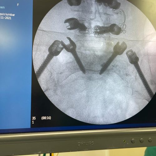 instrumentacionlumbosacra