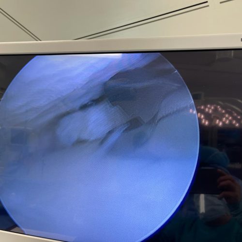 remodelacion por condromalacia 2