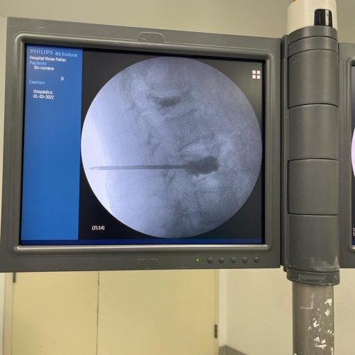 vertebroplastia2